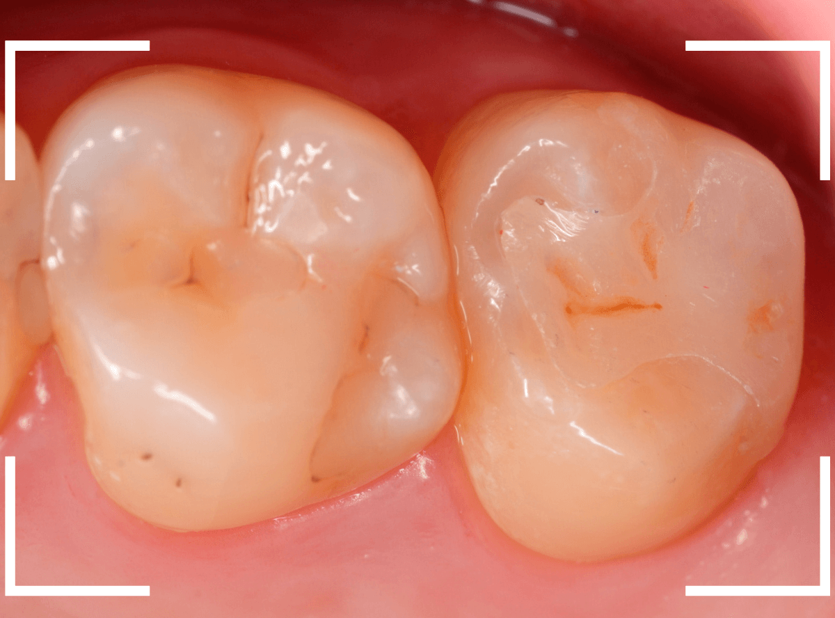気づかないうちに深い虫歯5-7