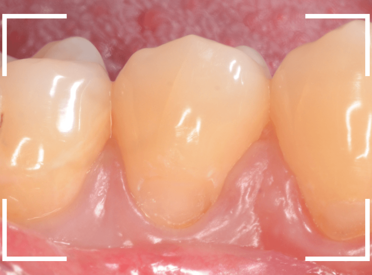 知覚過敏の画像3-2