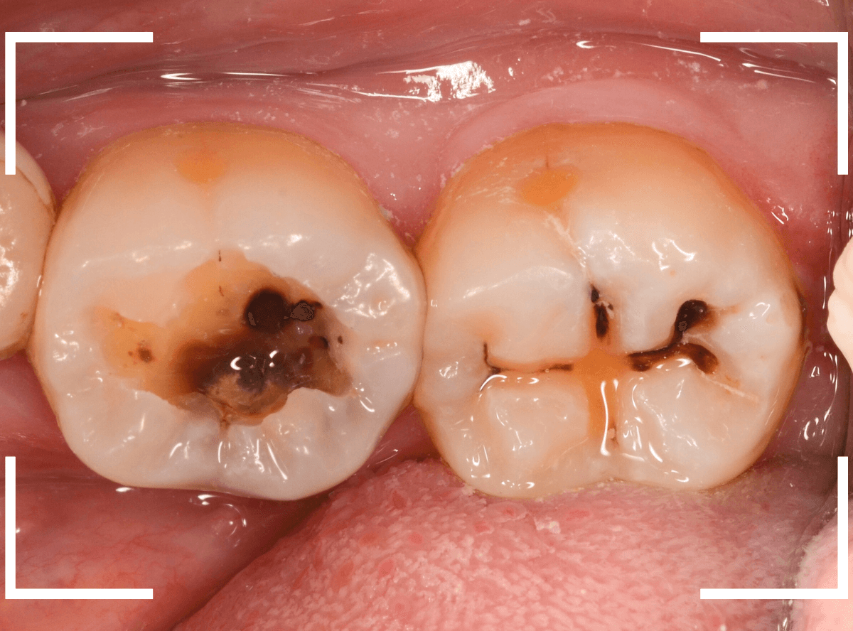 小窩裂溝う蝕2-4