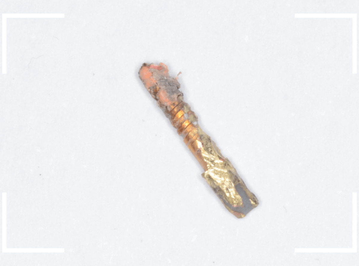 歯の土台の再治療3-5