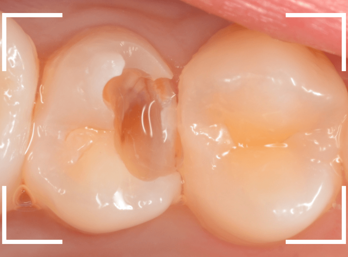 セラミック治療(インレー)32-7
