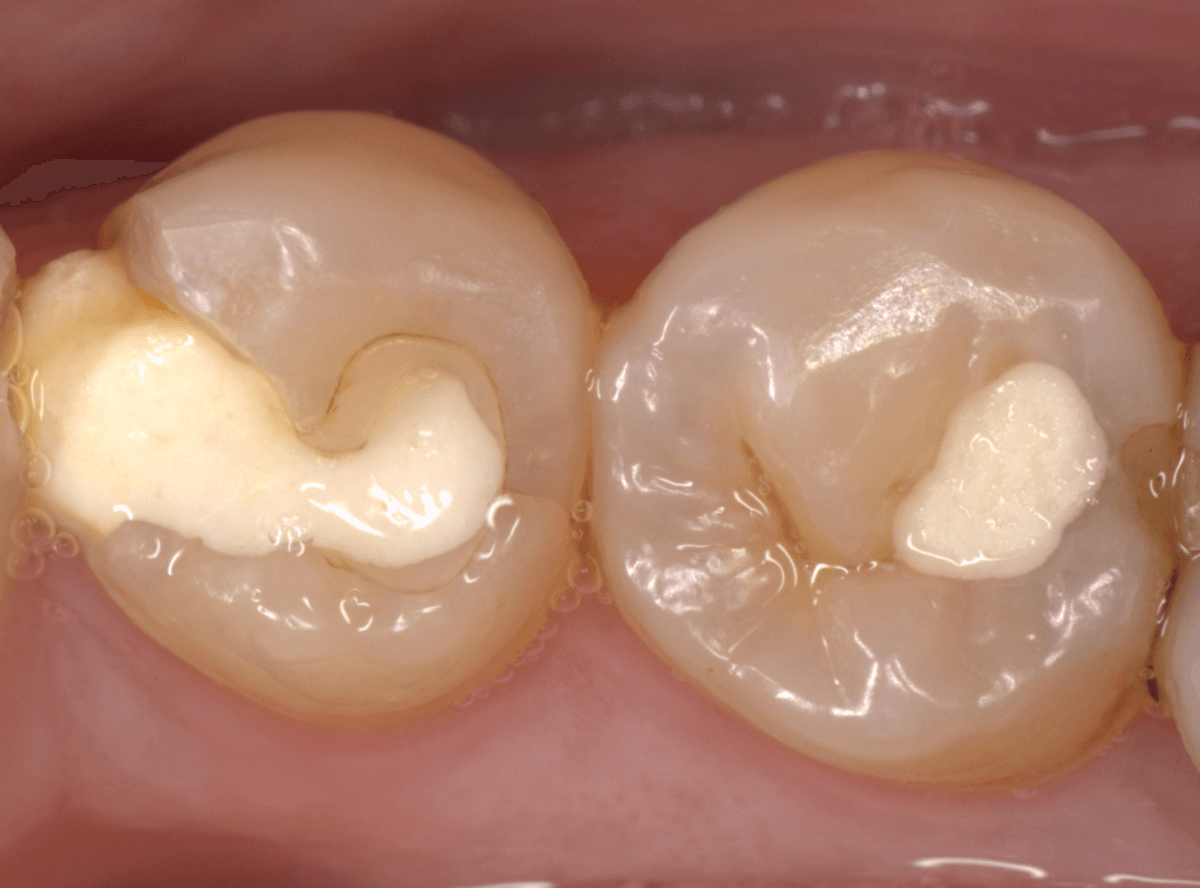 セラミック治療(インレー)13-1