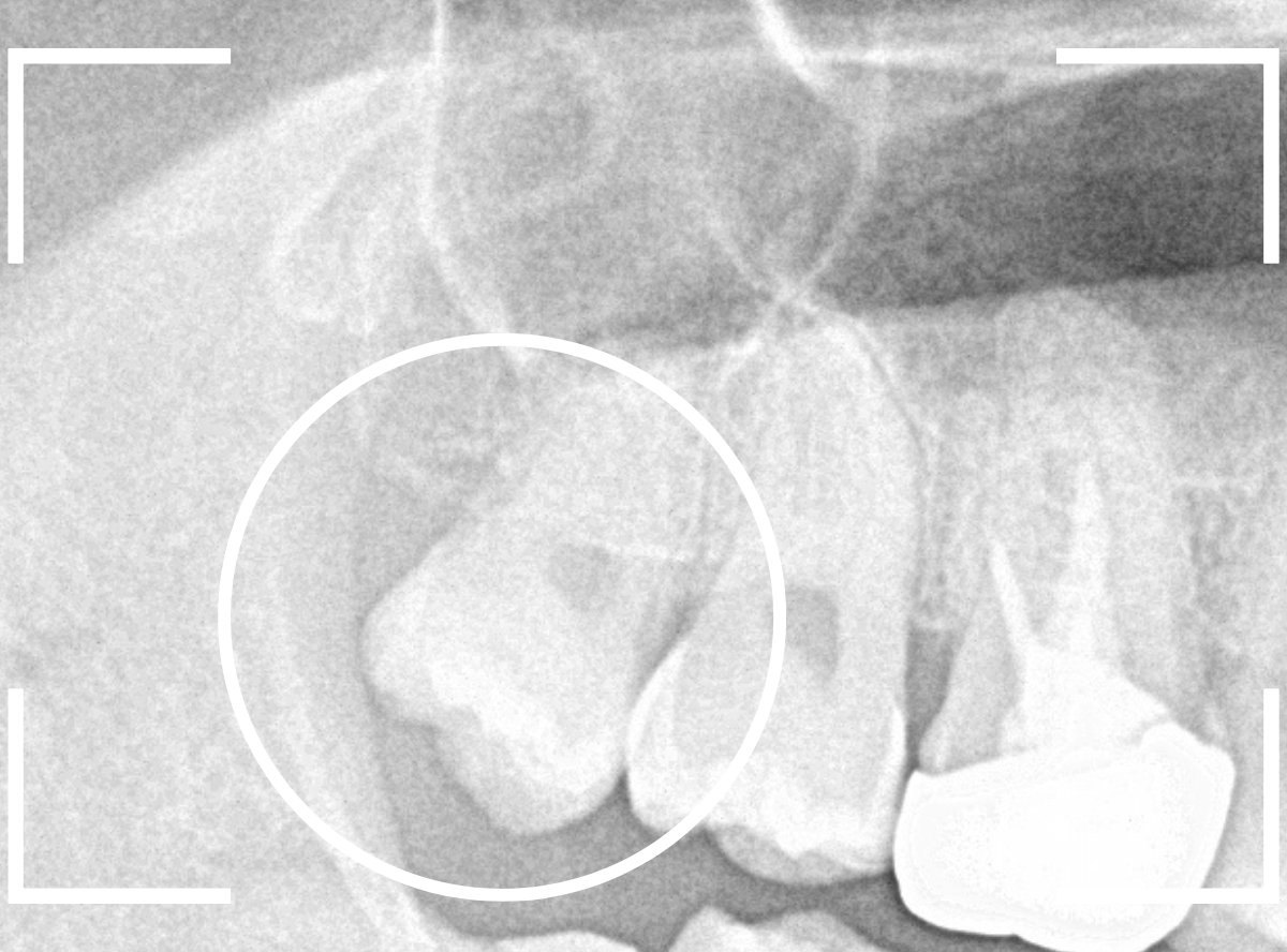 おやしらずの抜歯9-2