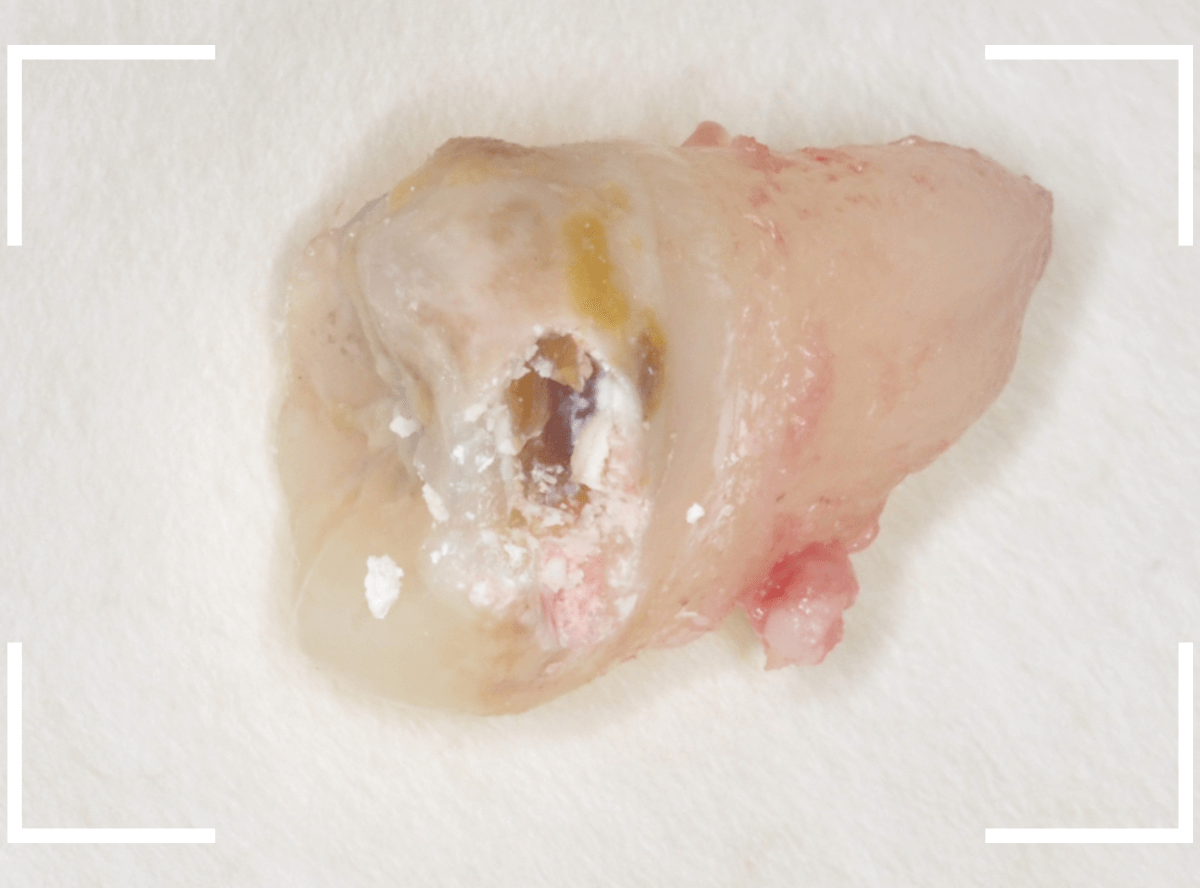 おやしらずの抜歯16-3