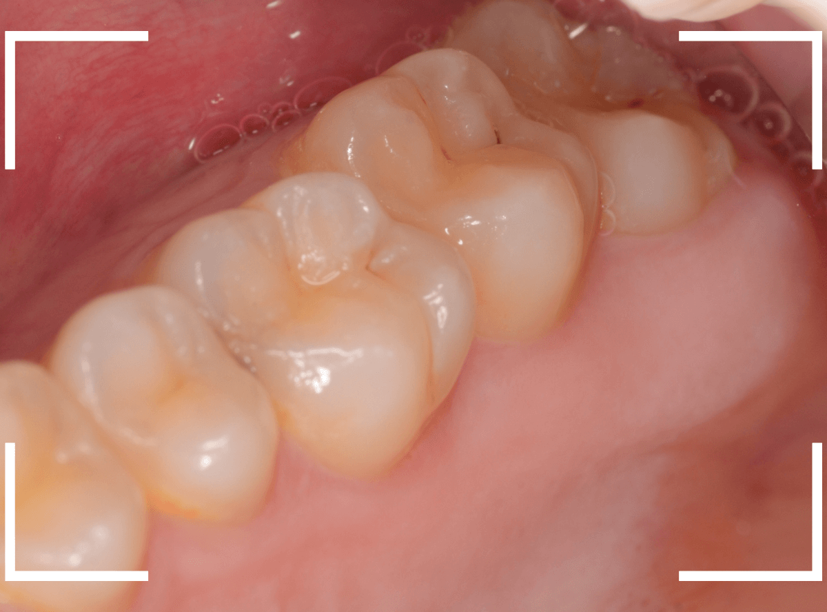 おやしらずの抜歯14-2