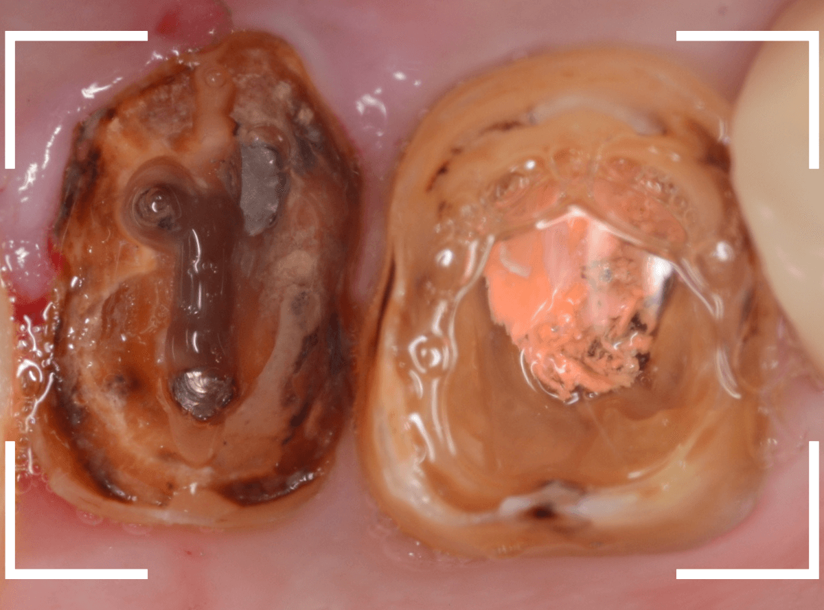 歯の土台の再治療3-7