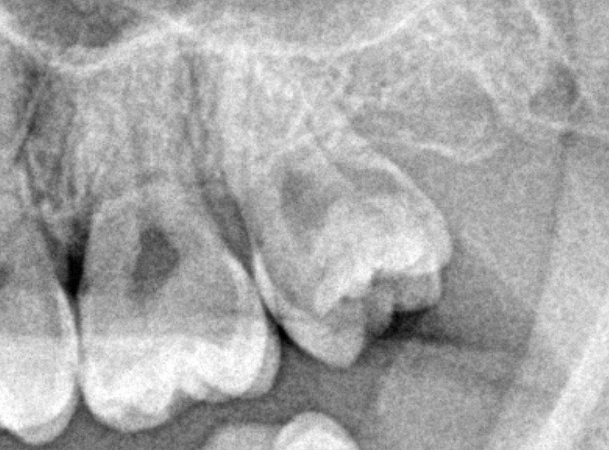 おやしらずの抜歯1-3