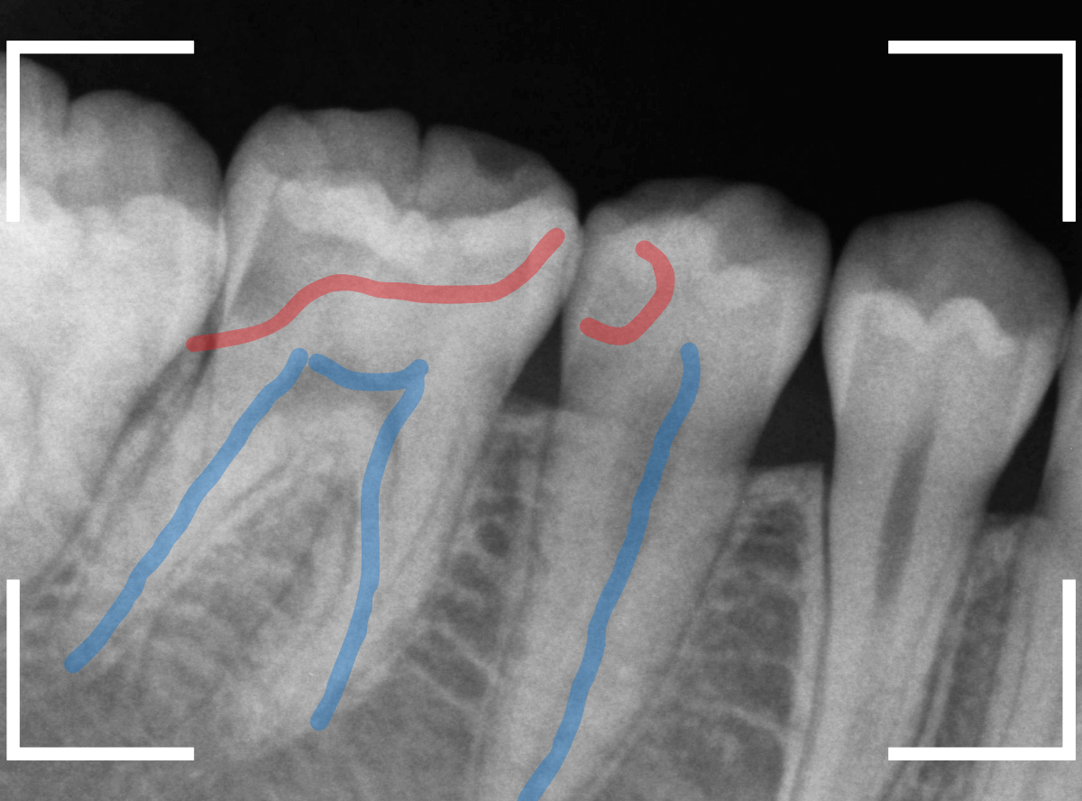 小窩裂溝う蝕1-3