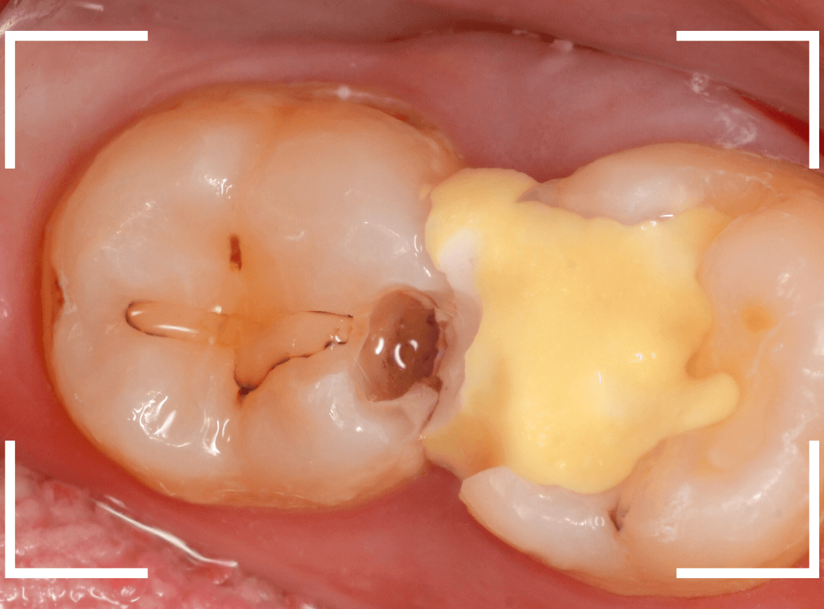 歯と歯の間の虫歯23-7