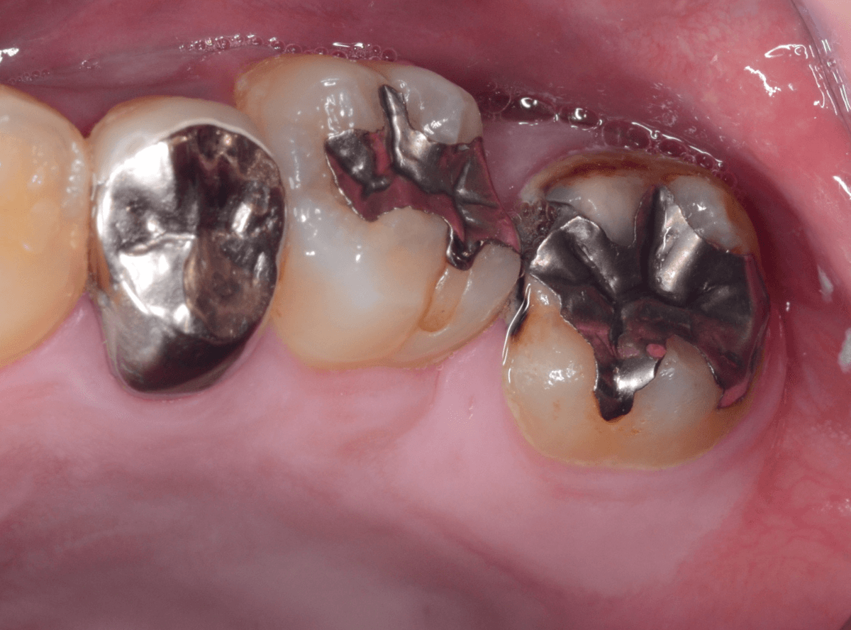 つめものの下の深い虫歯(画像)4-1