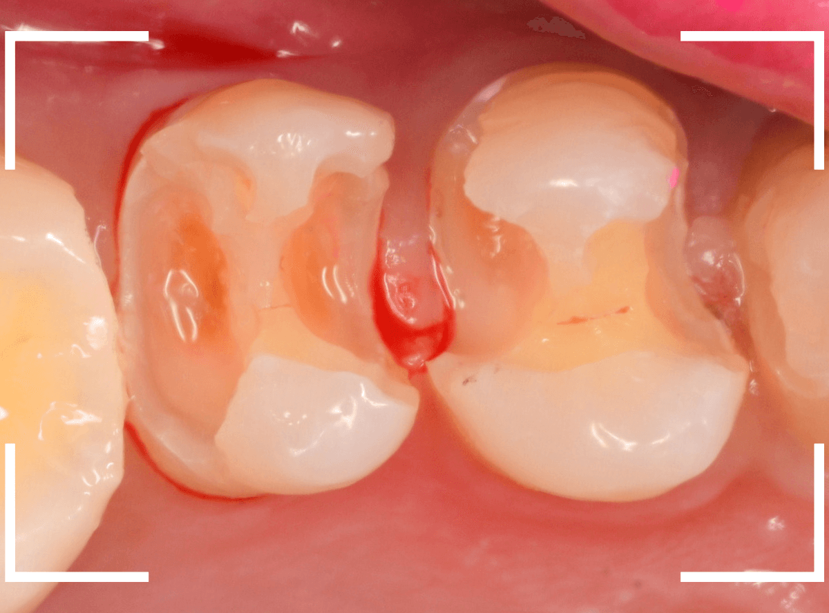気づかないうちに深い虫歯8-5