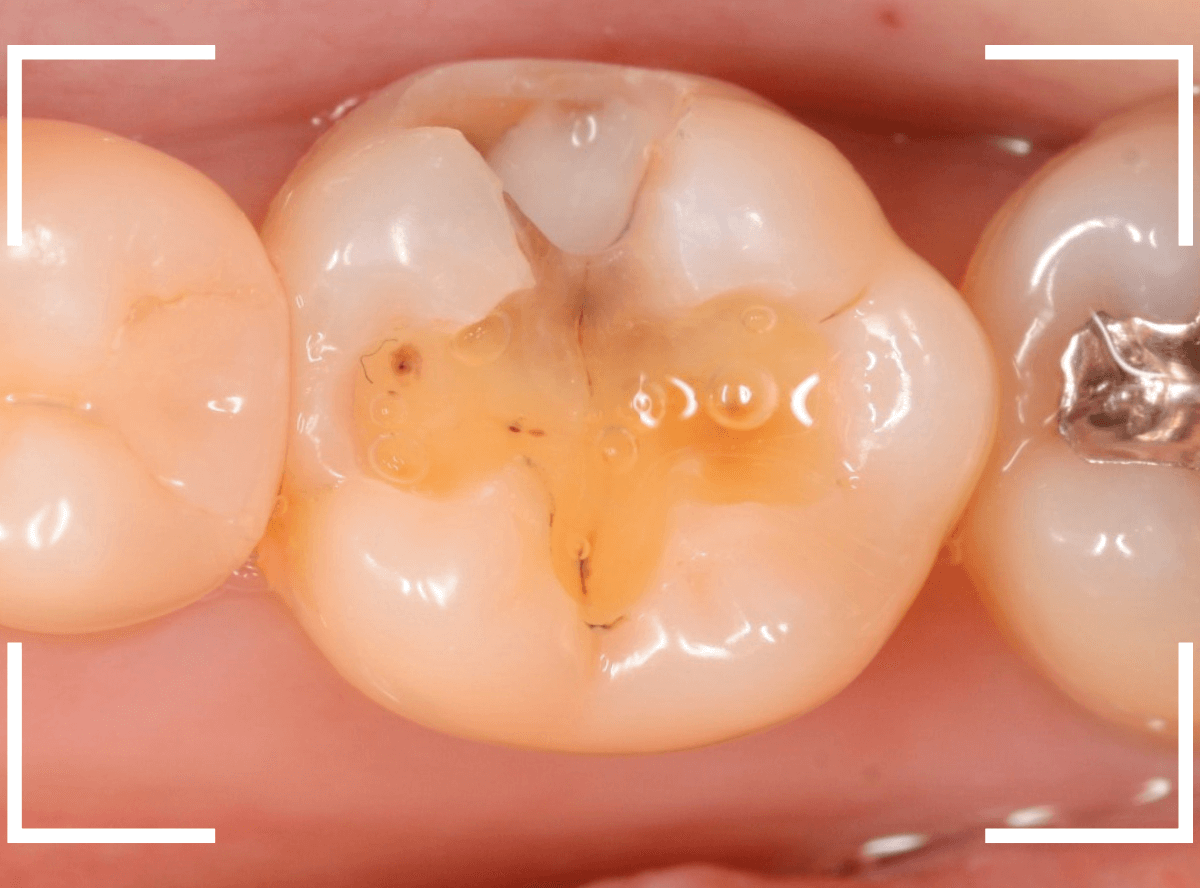 つめものの下の深い深い虫歯20-1