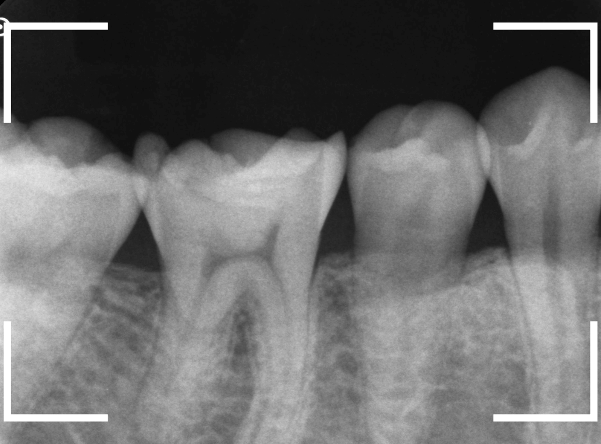 レントゲンでわかりづらい虫歯21-2