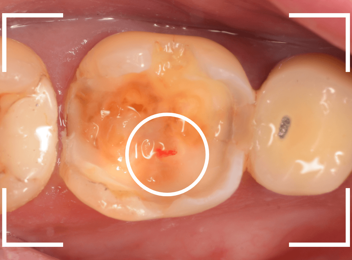レントゲンでわかりづらい虫歯19-4