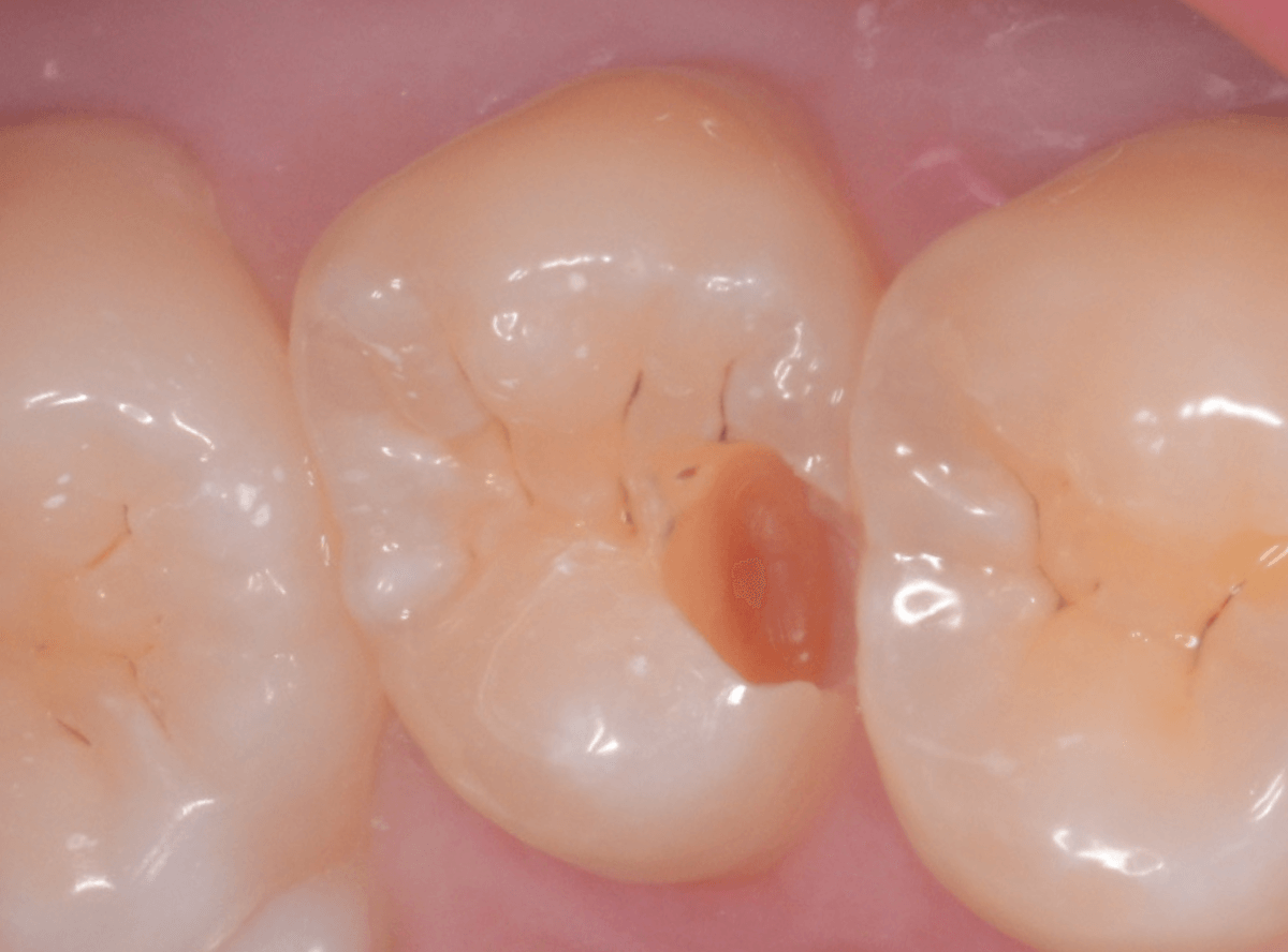 レントゲンでわかりづらい虫歯2-5