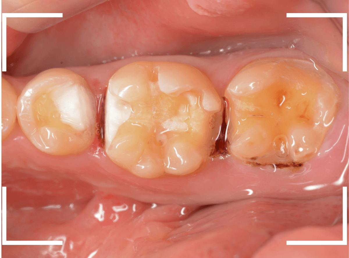 歯の治療の器具_ベースセメント-7