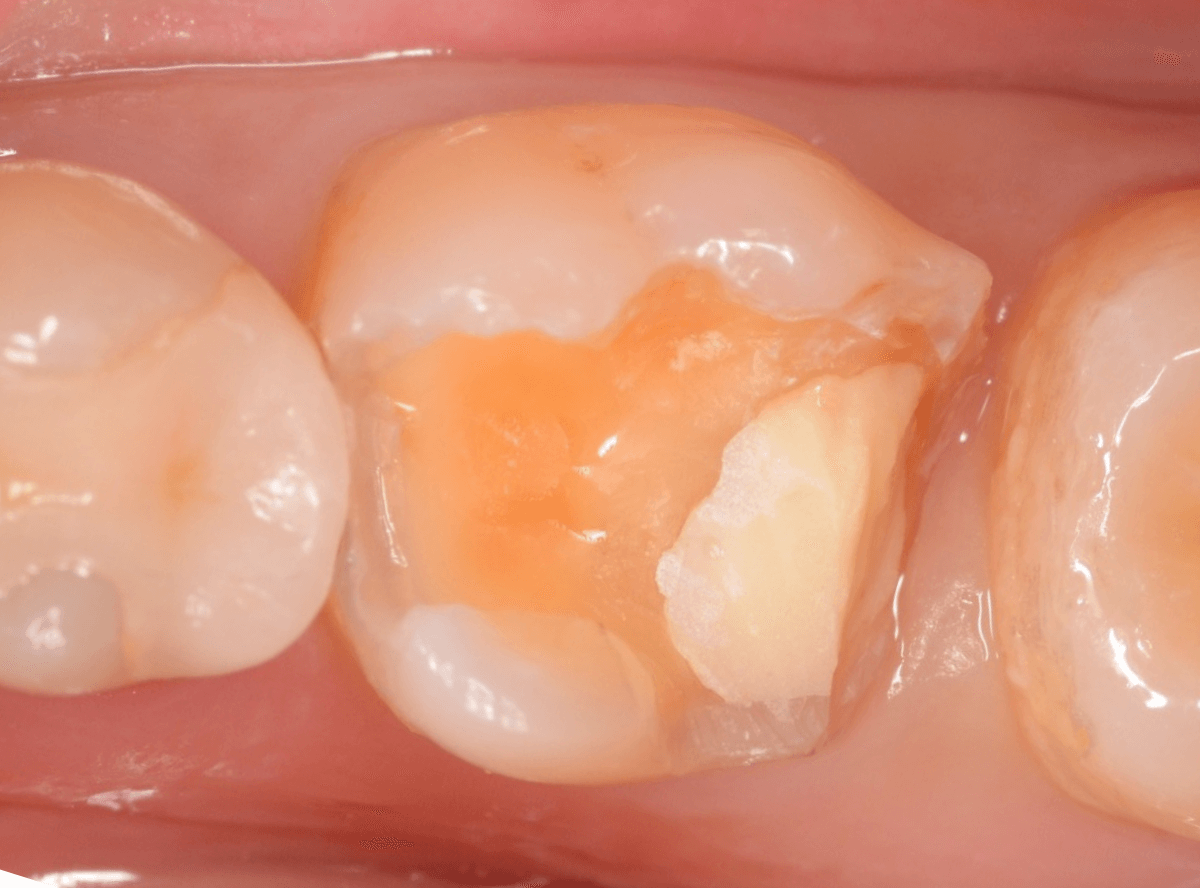 セラミック治療(インレー)12-2