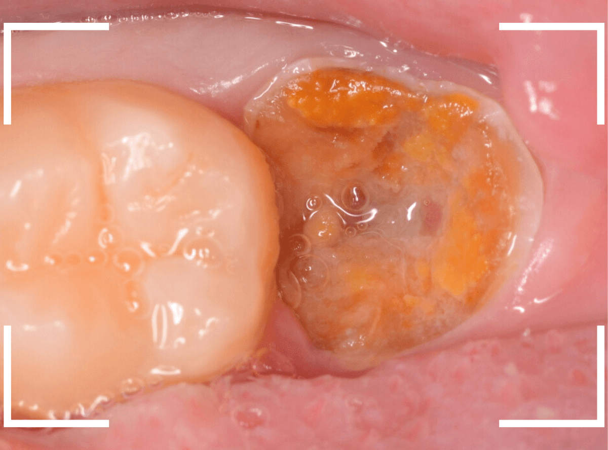 おやしらずの抜歯12-1