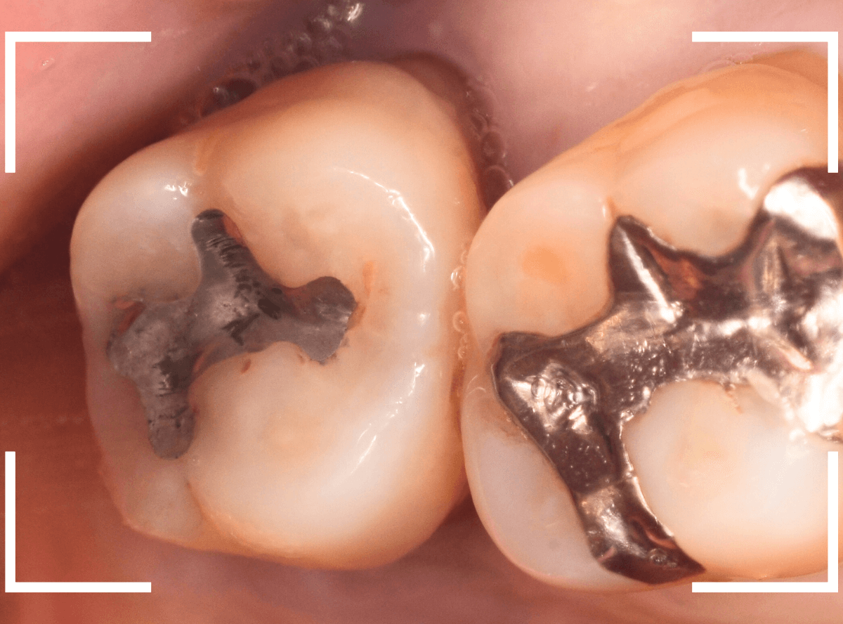 歯周病が原因で、抜歯2-1