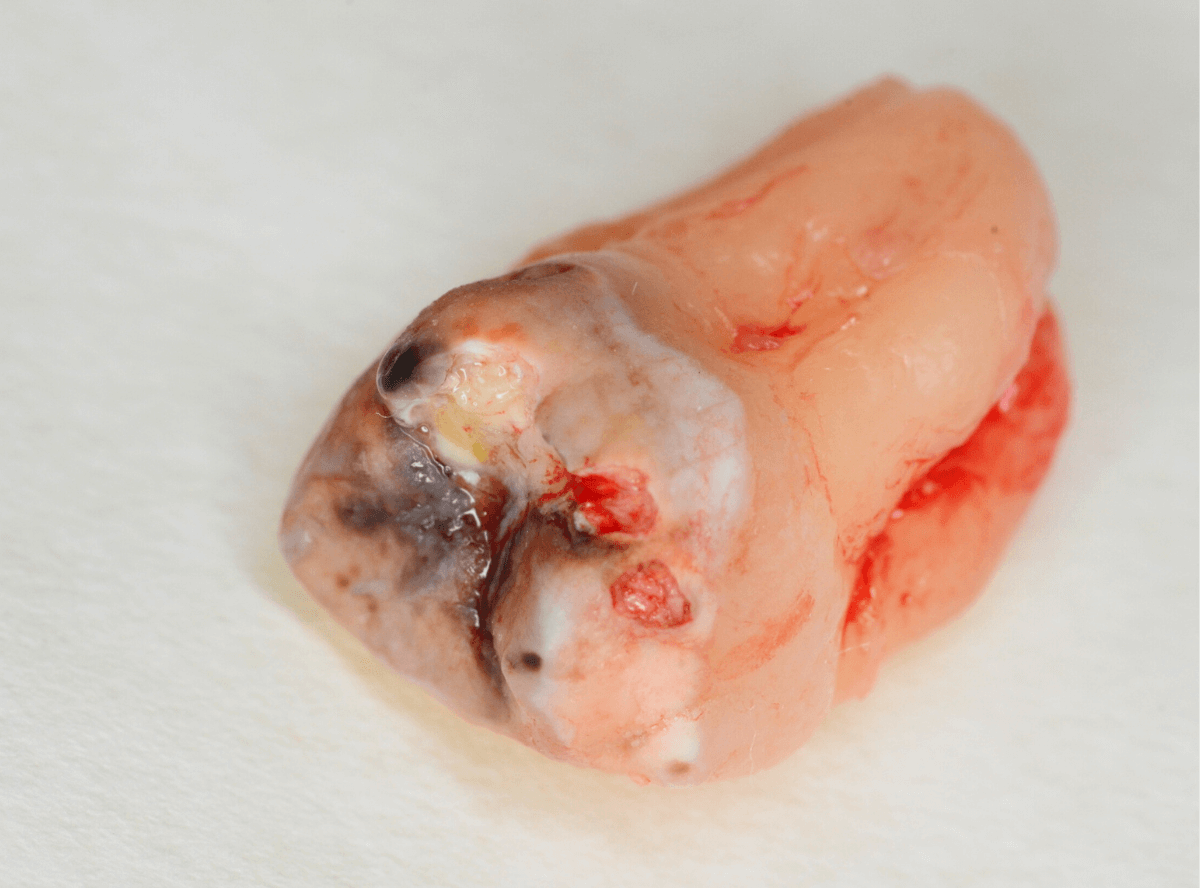 おやしらずの抜歯7-2