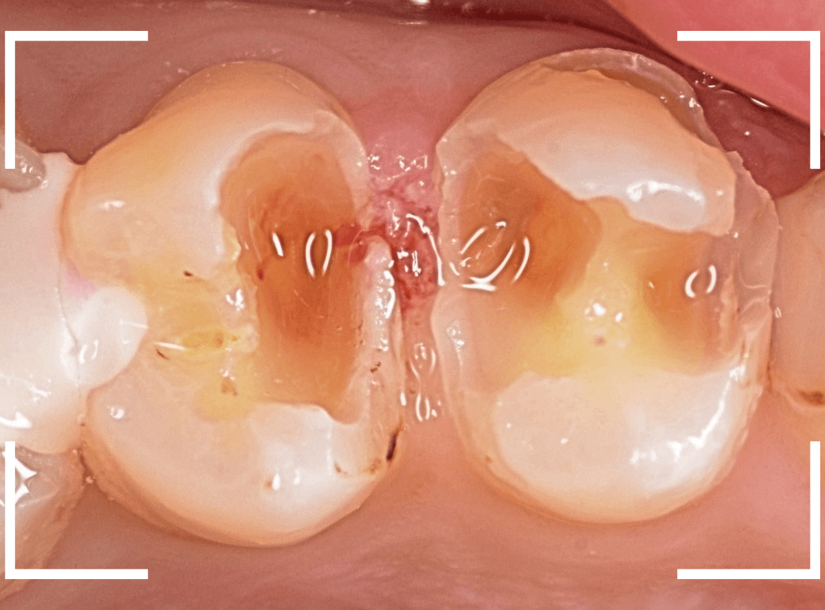 つめものの下の深い虫歯(画像)10-1