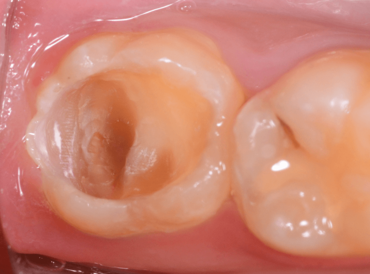 つめものの下の深い深い虫歯11-1