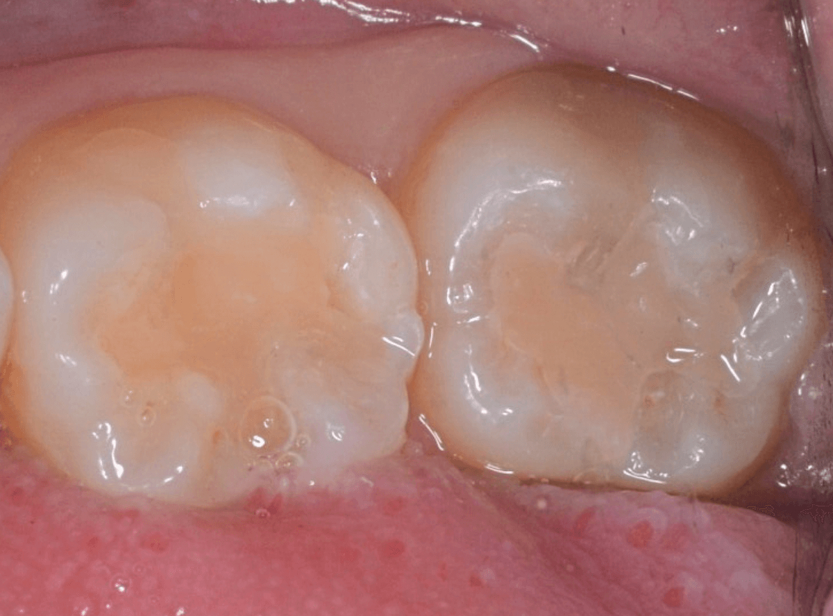 コンポジットレジン治療3-5