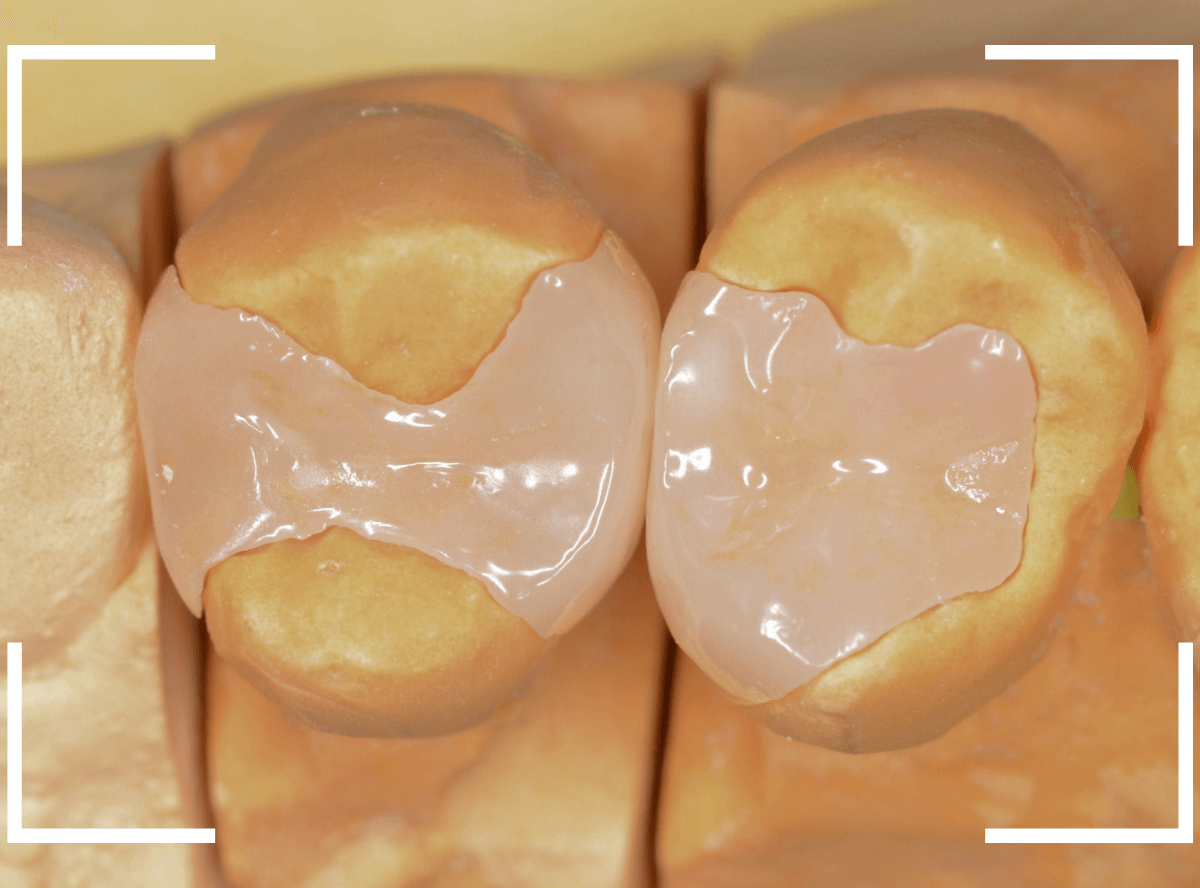 セラミック治療(インレー)28-3