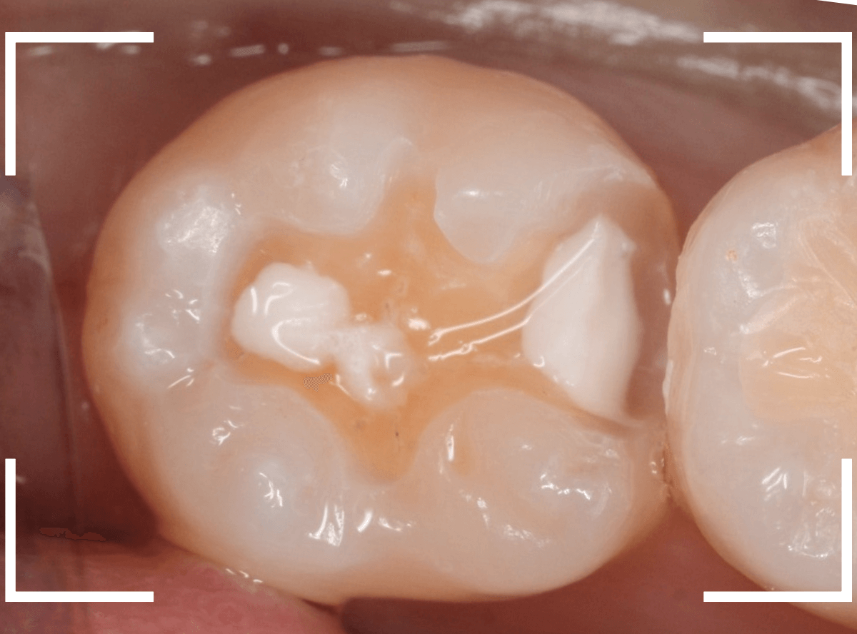 セラミック治療(インレー)16-2
