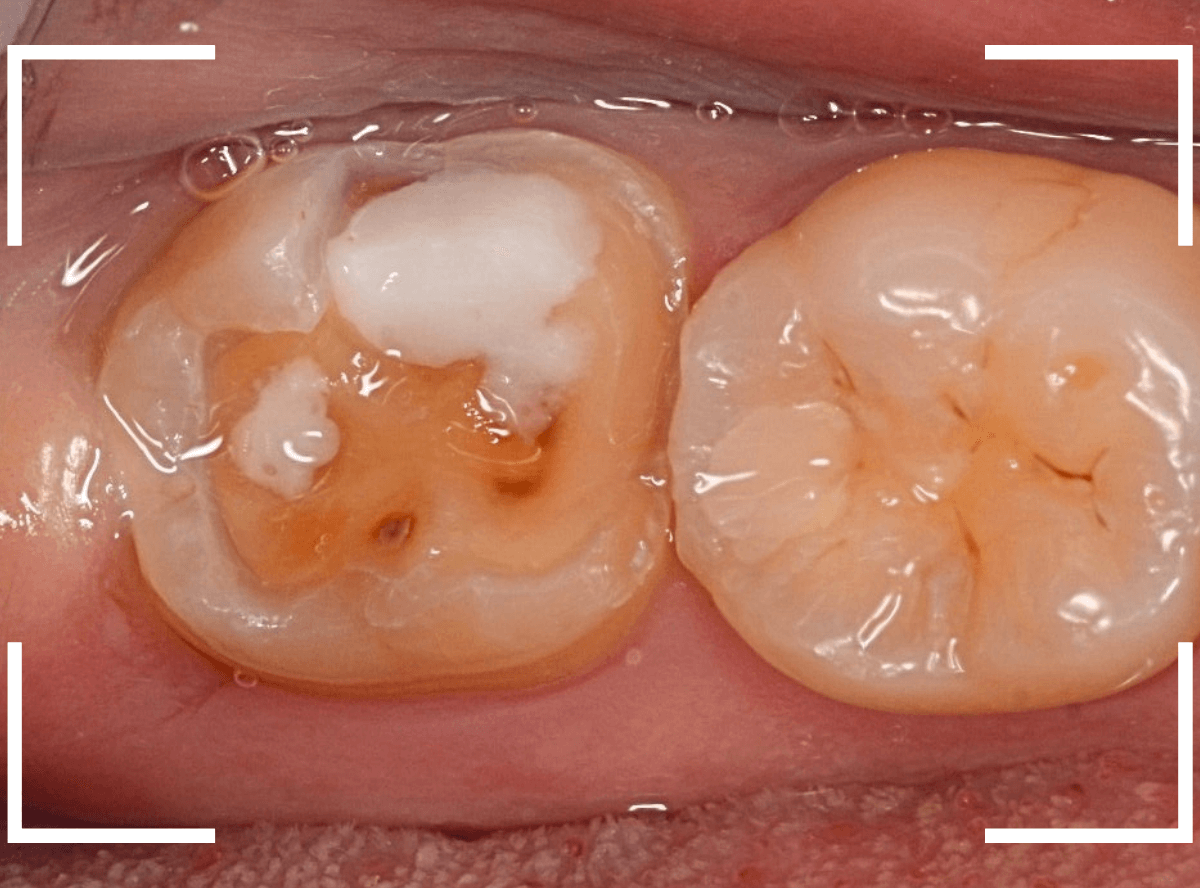 セラミック治療(インレー)20-2