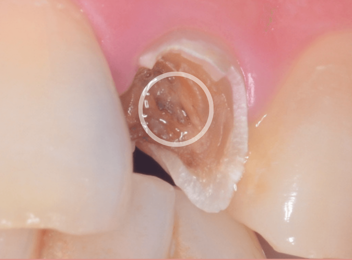 「前歯が折れた」という患者さん-2