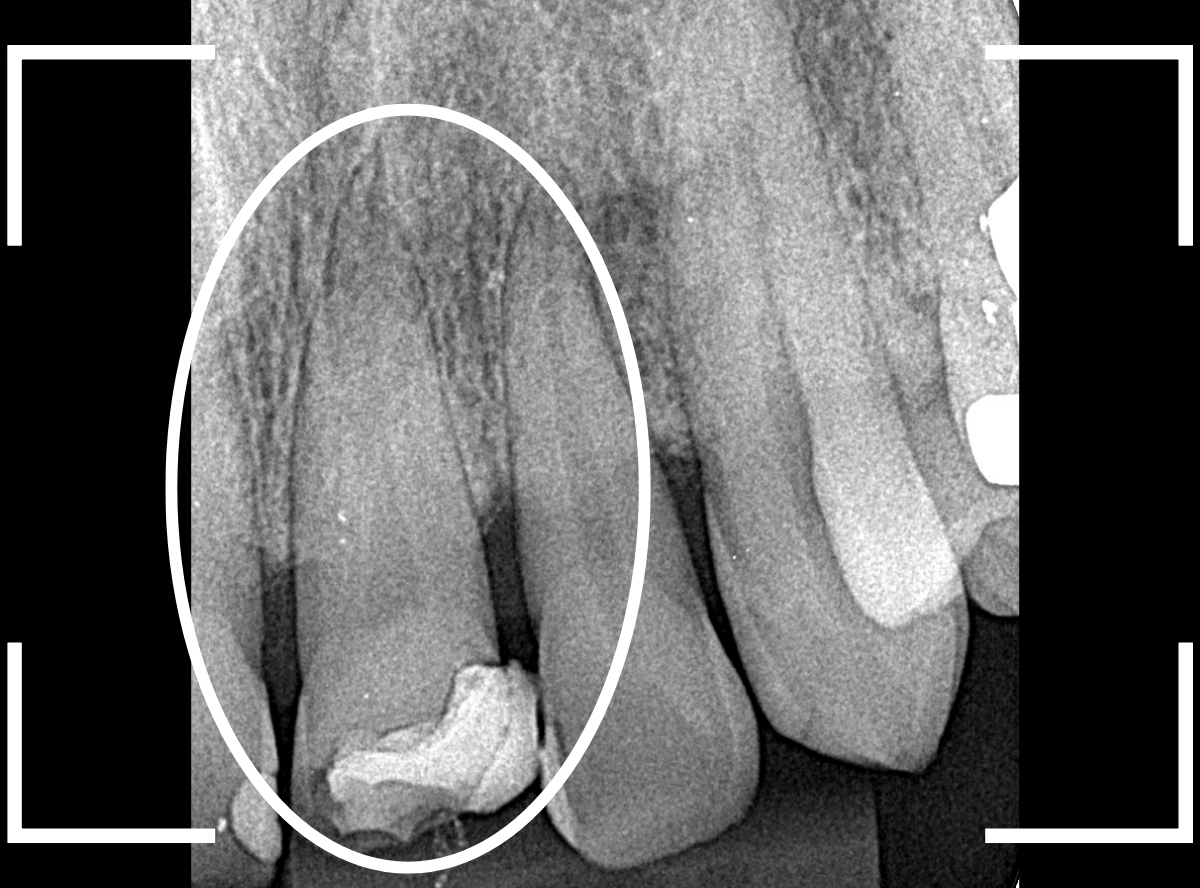 セラミック治療(前歯・クラウン)5-3