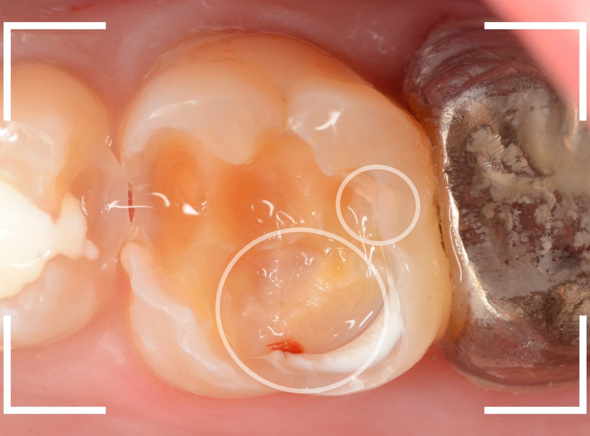 つめものの下の深い深い虫歯20-1