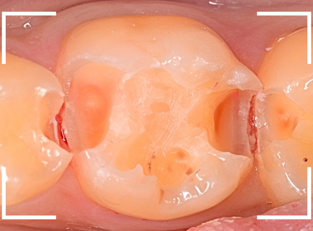 レントゲンでわかりづらい虫歯6-5