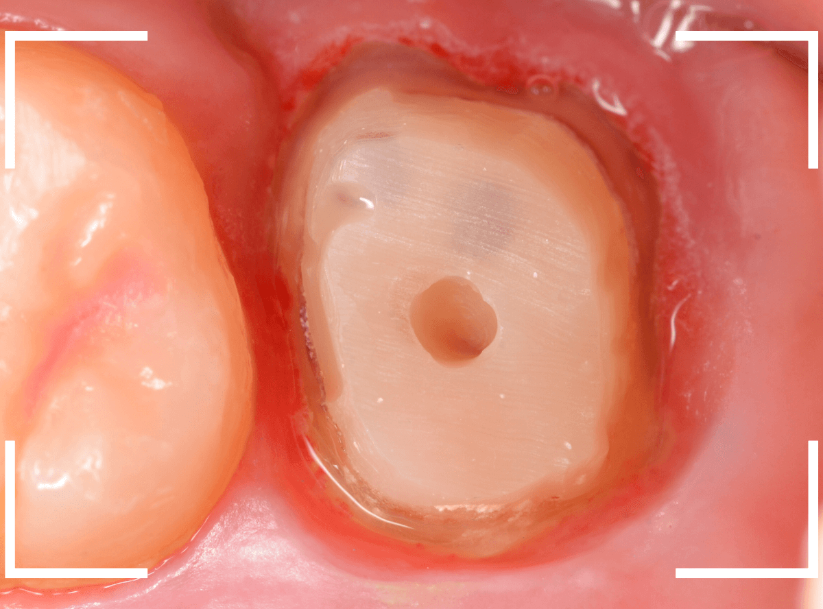 セラミック治療(クラウン・奥歯)10-5