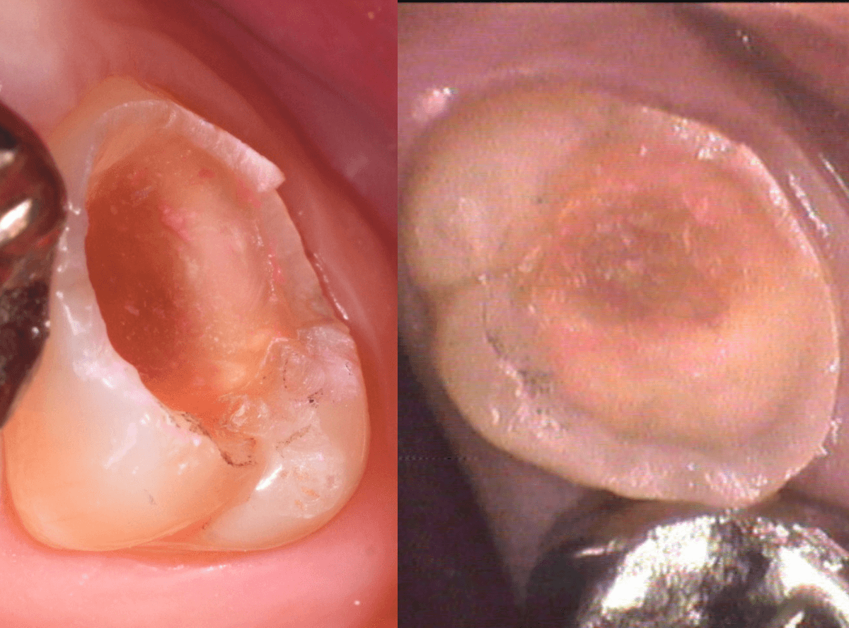 気づかないうちに深い虫歯2-4