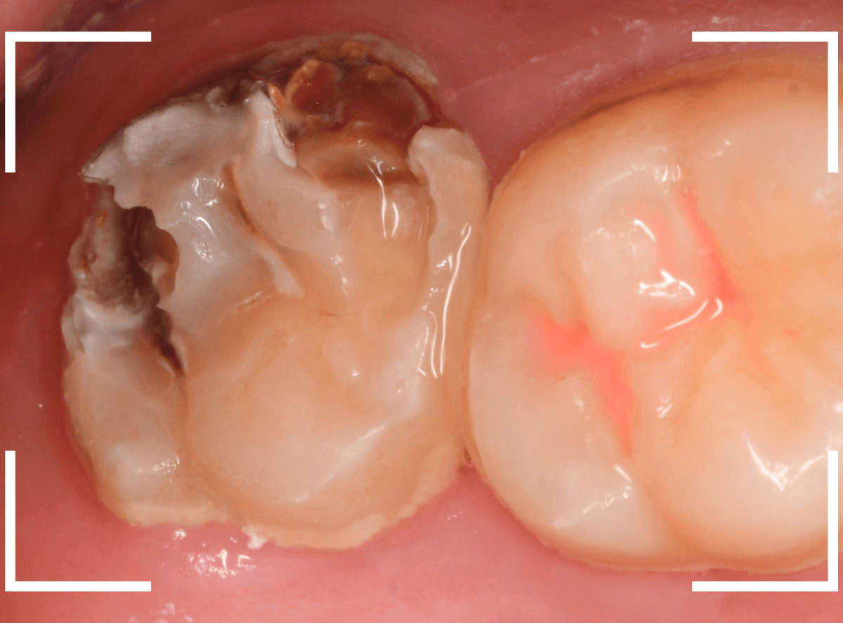 気づかないうちに深い虫歯6-3