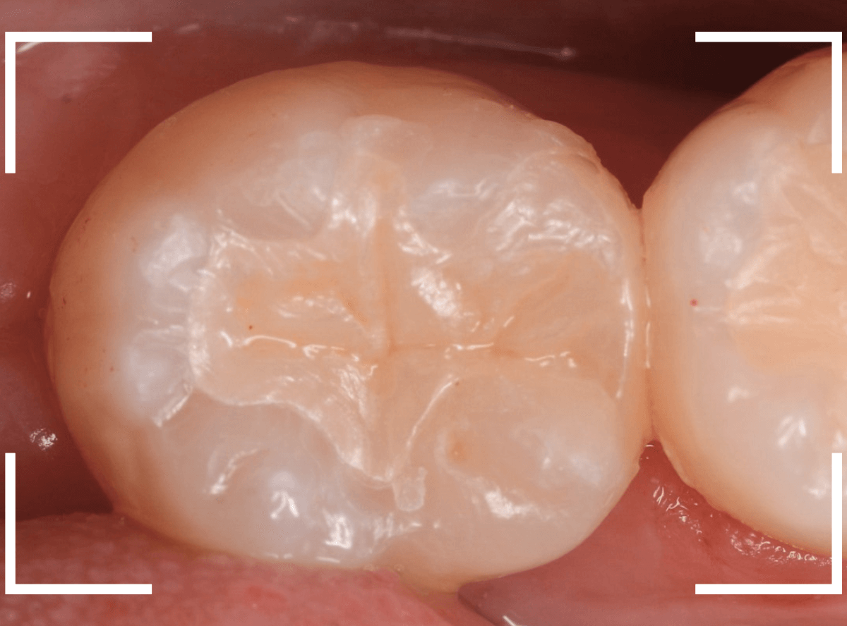セラミック治療(インレー)16-4