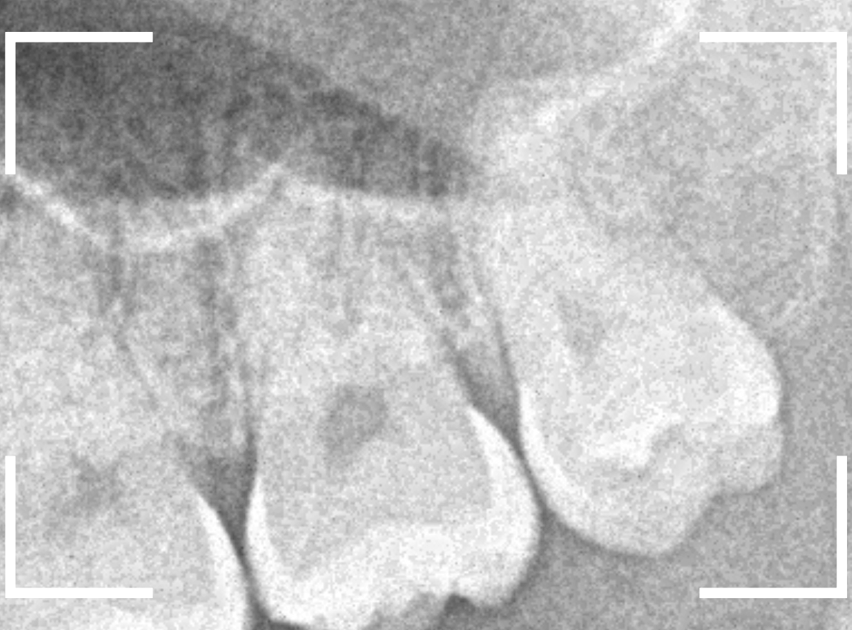 おやしらずの抜歯10-2