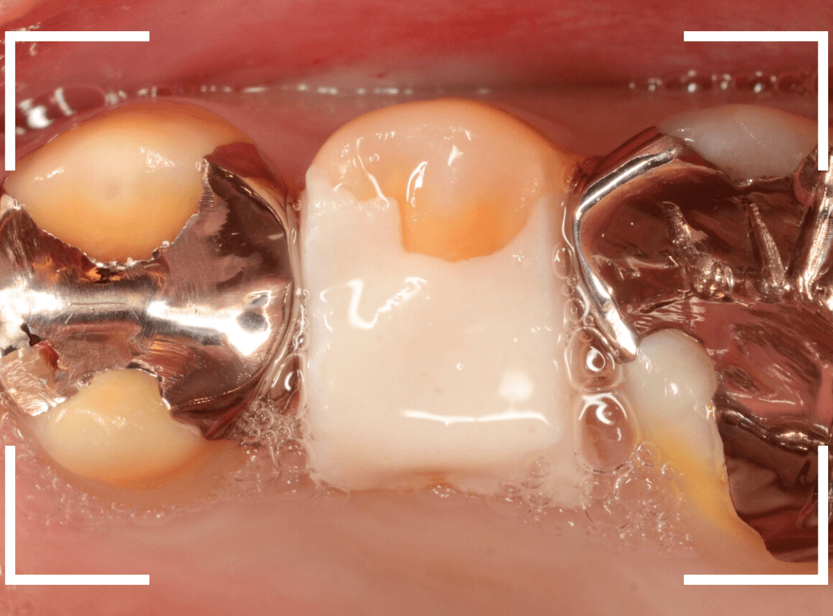 セラミック治療(クラウン・奥歯)13-1