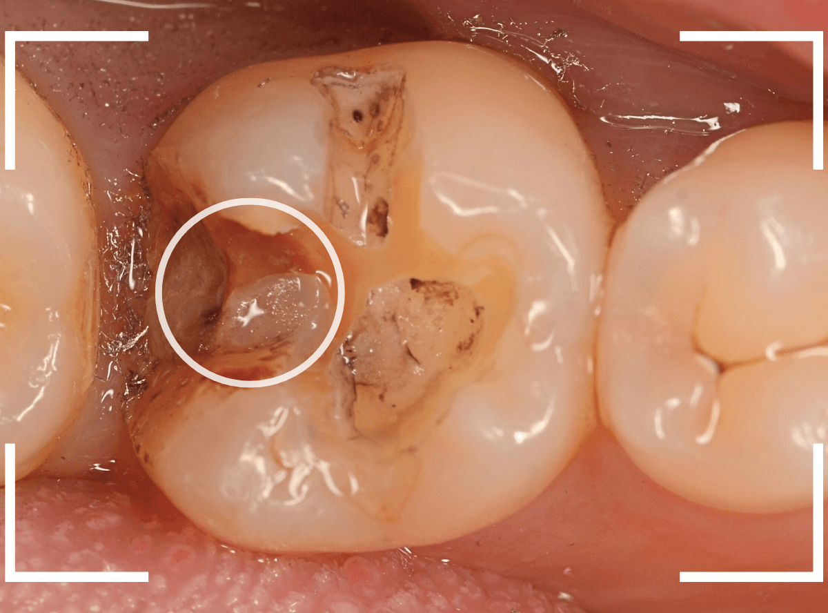 つめものの下の深い虫歯(画像)10-1