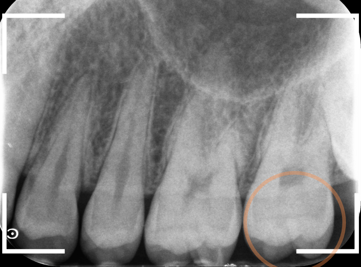 小窩裂溝う蝕4-2