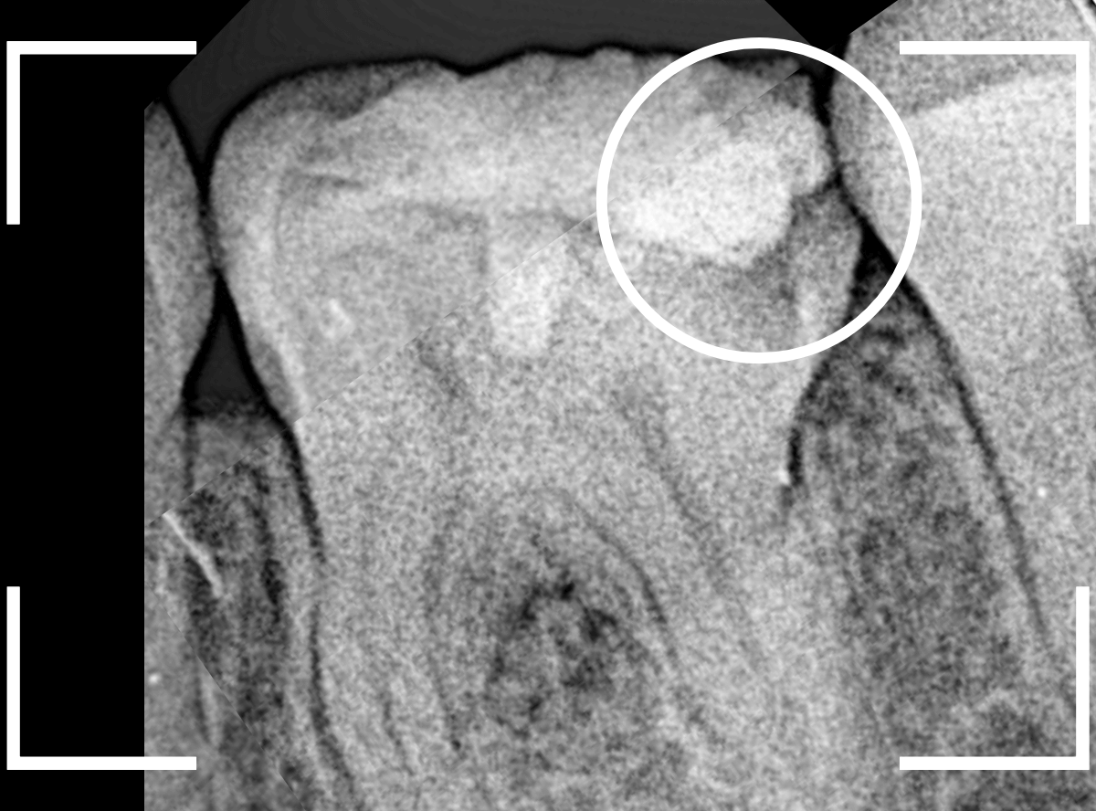 つめものの下の深い深い虫歯11-2