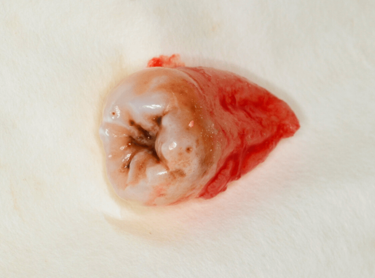 おやしらずの抜歯2-2