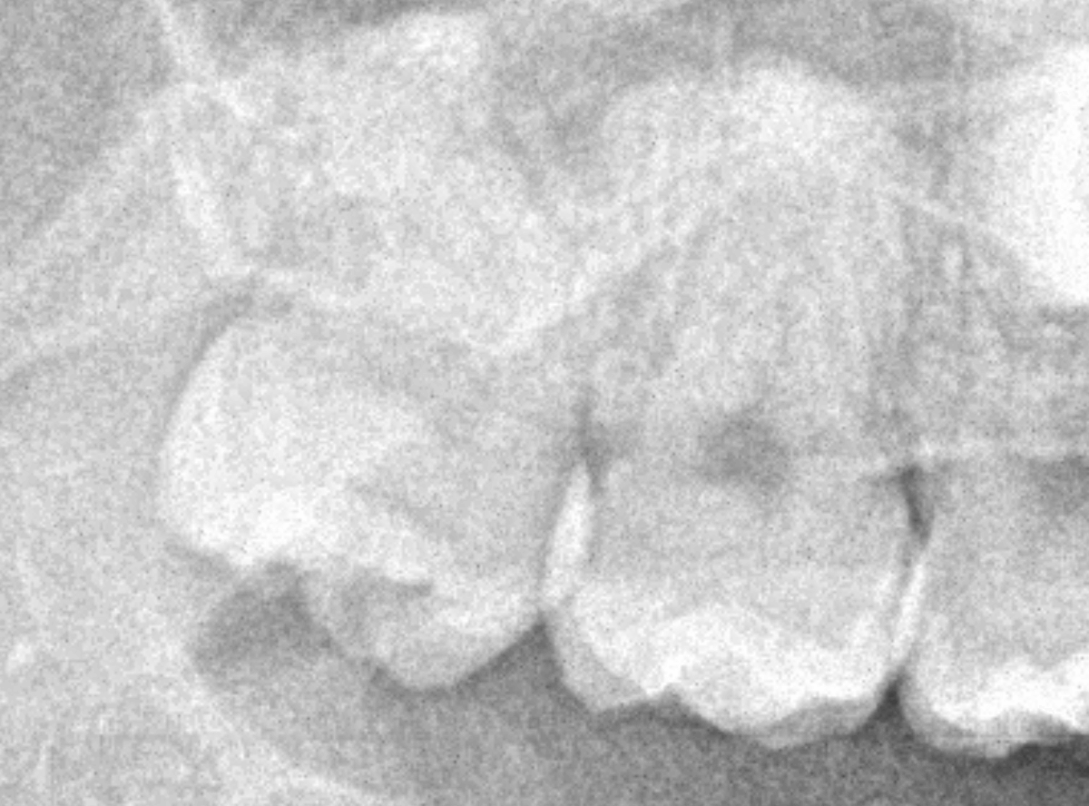 おやしらずの抜歯3-1