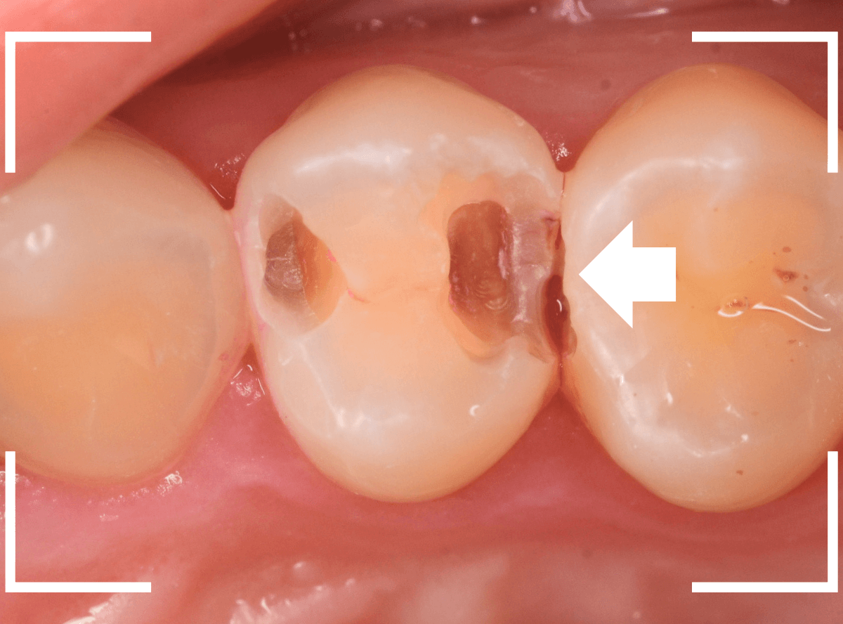 歯と歯の間の虫歯7-4