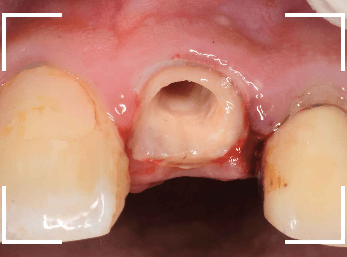 歯肉の中の歯石（歯肉縁下歯石）除去(画像）5-7