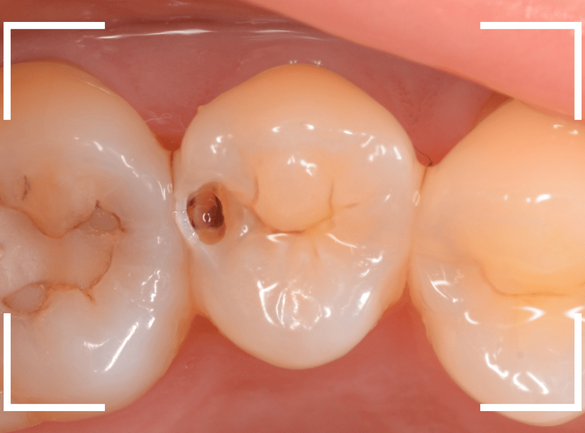 レントゲンでわかりづらい虫歯9-3