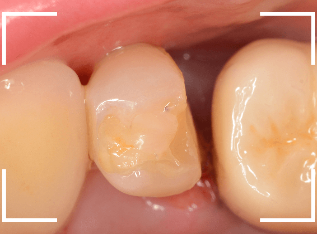 セラミック治療(クラウン・奥歯)8-1