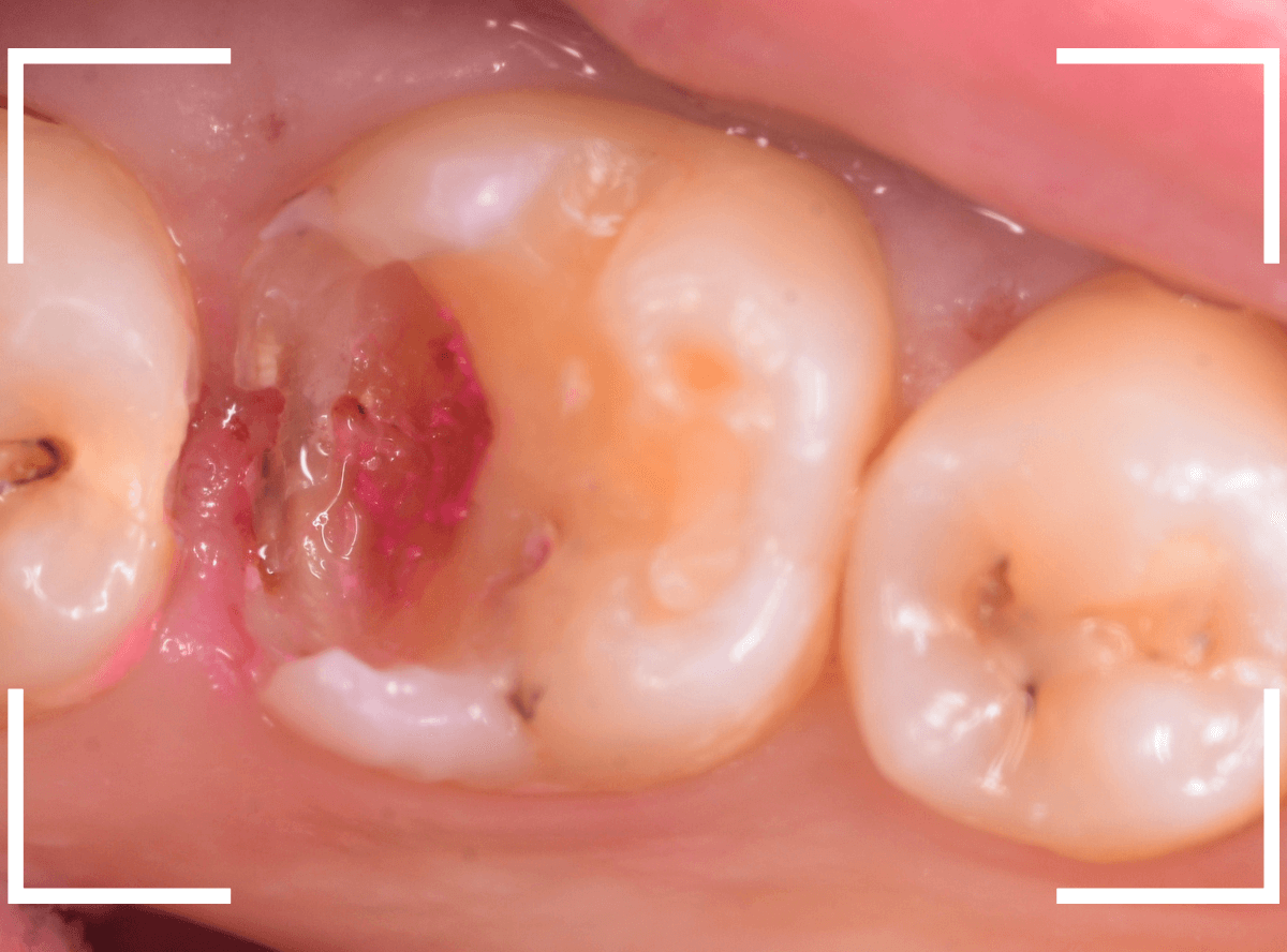 歯と歯の間の虫歯23-4